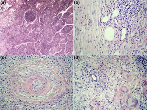 Typical Pathological Characteristics Of Syphilitic Lymphadenopathy A