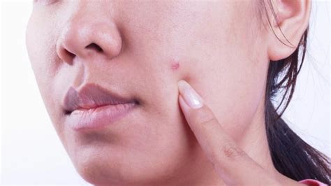 8 Natural Remedies For Pimples To Cure Quick