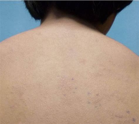 Allergic Reaction Skin Rashes Images 10lilian