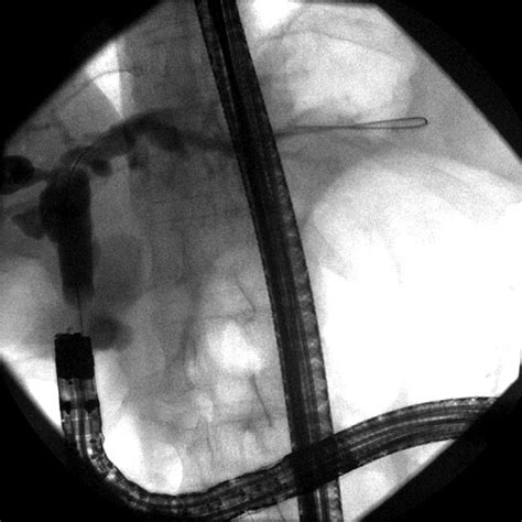 Pdf Endoscopic Retrograde Cholangiopancreatography