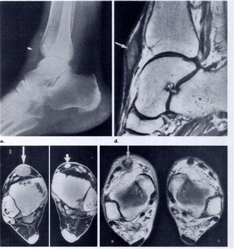 Spontaneous Rupture Of The Anterior Tibial Tendon In A Patient Who