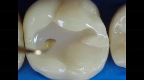 Impressive Reconstruction Dental Composite Resin Youtube
