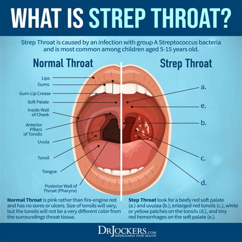 Strep Throat Symptoms And Natural Support Strategies