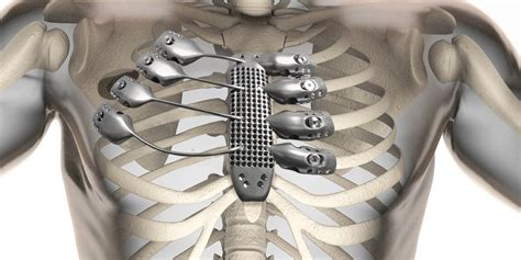 The rib cage is the arrangement of ribs attached to the vertebral column and sternum in the thorax of most vertebrates, that encloses and protects the vital organs such as the heart, lungs and great vessels. 3D-Printed Titanium Rib Cage Designed For Cancer Patient Makes Medical History | HuffPost UK
