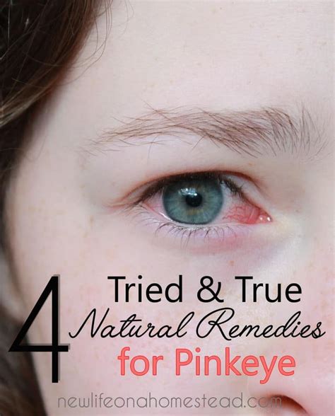 12 Tried And True Natural Remedies For Pinkeye • New Life On A