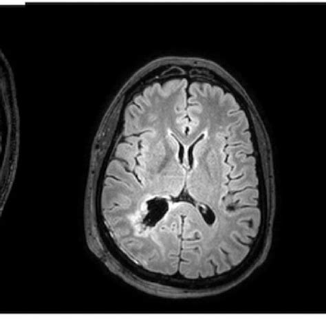 A C Sagittal T Axial Flair And Coronal Flair Sections Of Mri