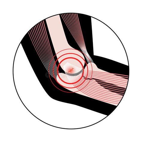 Epicondilitis Medial Codo De Golfista Ilustración Del Vector