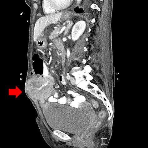 Ct Of The Abdomen And Pelvis With Iv And Oral Contrast Sagittal View