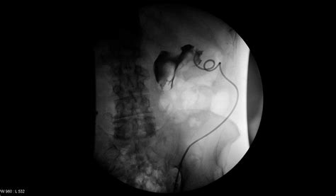 Emergent Nephrostomy Tube Placement For Acute Urinary Obstruction