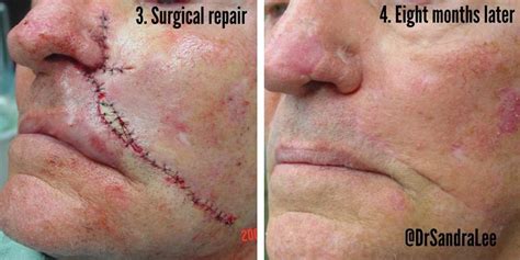 Photos Of Skin Cancer Surgery — Skin Cancer Removal On The Face