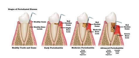 Tooth Gum Diagram