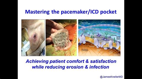 The icd works by shocking the heart and restarting it if a person goes into cardiac arrest or. Mastering the Pacemaker/ICD pocket for patient ...