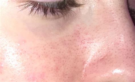 What product criteria are often mentioned in best ordinary products for blackheads? Skin Concern Are these blackheads or enlarged pores? And ...