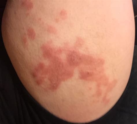 I Have Had This Rash For About 2 3 Months Now Ask A Doctor Free