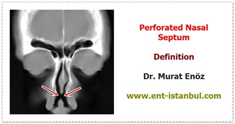 Nasal Septum Perforation Definition Causes Symptoms Diagnosis And Treatment