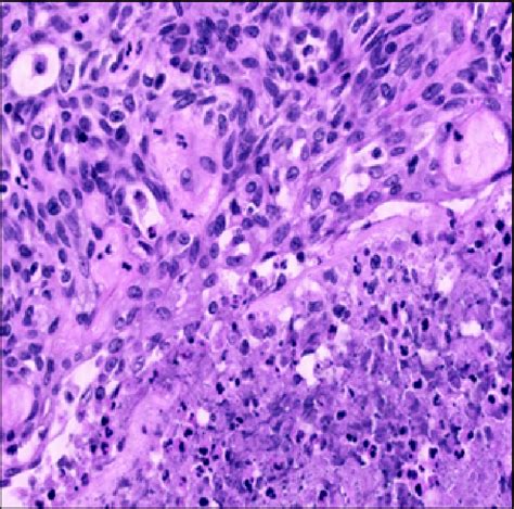 Histology Of Thymoma Atypical Type A Component Download Scientific