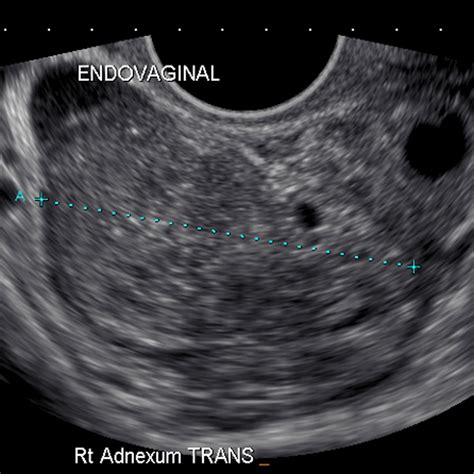 If the question is more, is it possible for a baby to be missed in an. Image | Radiopaedia.org