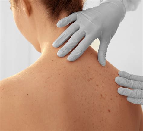 Birthmarkspigmented Skin Complete Care Dermatology Dermatologist