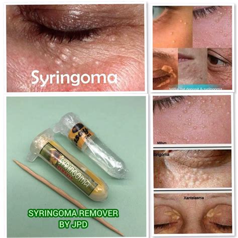Syringoma Remover By Jpd 100 Safe Effective 2ml With Free Oil Ebay