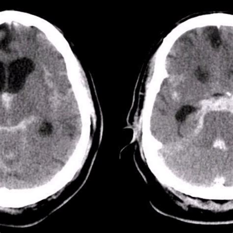 Mechanism Of Early Brain Injury After Aneurysmal Subarachnoid