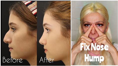 How To Get Rid Of Hook Nose And Nose Hump Naturally Get Straight Slim