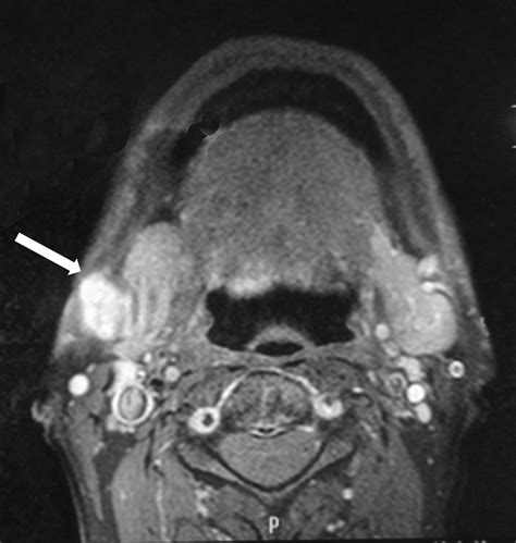 Pleomorphic Adenoma Of An Accessory Submandibular Salivary Gland A Rare Entity British