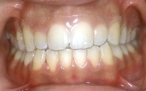 I have both retainers so this is just my intake on which are better. Types of Orthodontic Retainers - Tribeca Dental Care