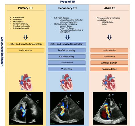 Prognostic Value Of Tricuspid Regurgitation