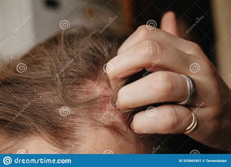 Psoriasis Vulgaris Psoriatic Skin Disease In Head Hair Skin Patches