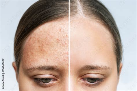 Cropped Shot Of A Young Womans Face Before And After Acne Treatment