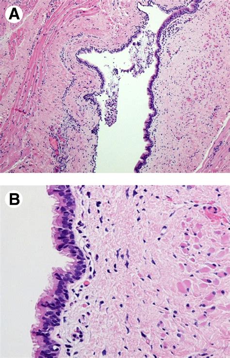 Congenital Mucocele In The Tongue Report Of A Case Journal Of Oral