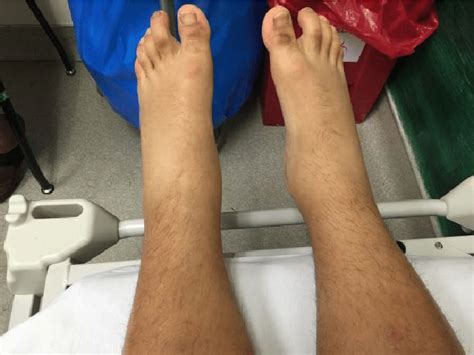 Patient With Acute Onset Of Bilateral Lower Extremity Edema Download