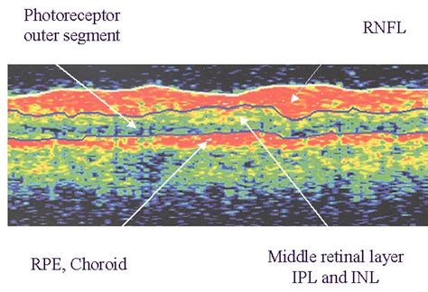 Interpretation Of Oct Scan Rnfl Retinal Nerve Fiber Layer Rpe