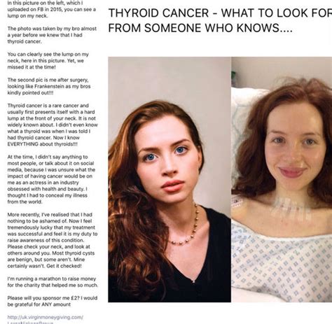 Thyroid Cancer Symptoms Girl Posts Photo Showing Hidden
