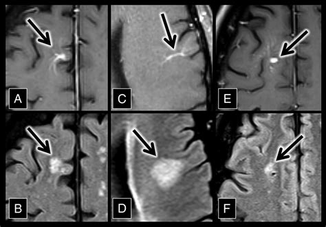 The Central Vein Flair Signal Abnormalities Associated With