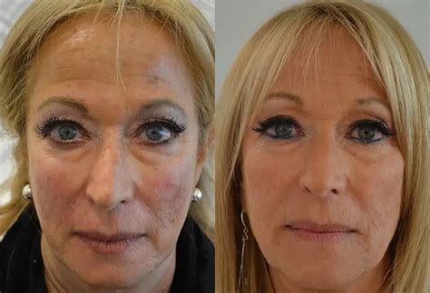 Dermal Fillers Before And After Dos And Donts For Wrinkles Lips And