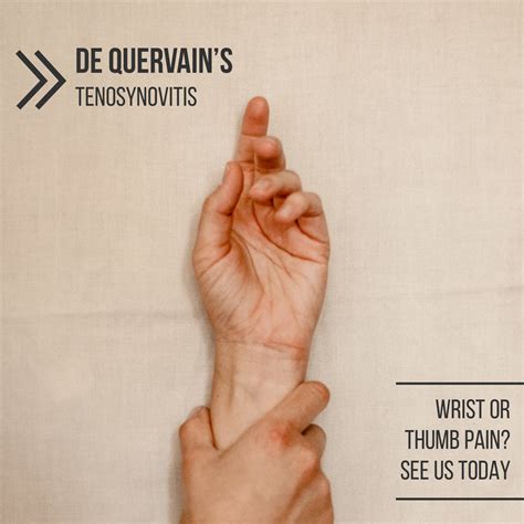 De Quervain S Tenosynovitis Beachealth