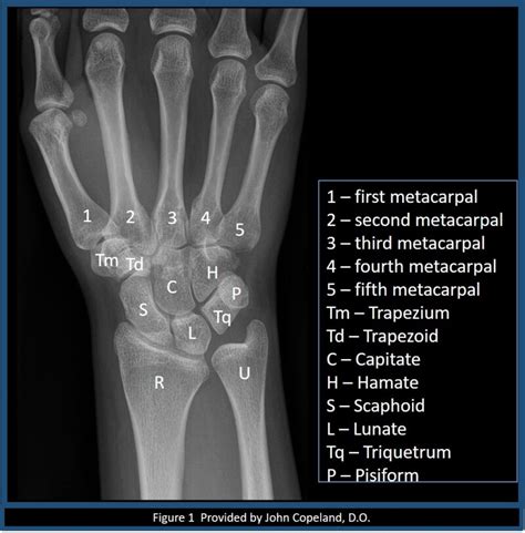 Figure Wrist X Ray With Labeled Osseous Anatomy Contributed By John Copeland DO