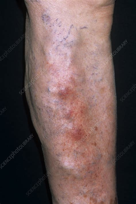 Superficial Thrombophlebitis Stock Image M175 0450 Science Photo