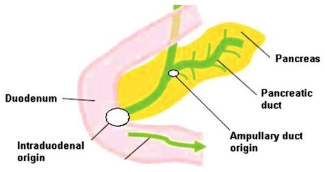 Ampullary Carcinoma Causes Symptoms Diagnosis Treatment Prognosis