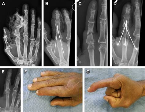 Treatment Of Nonunion And Malunion Following Hand Fractures Plastic