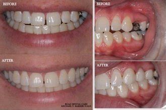 She came to limelight after appearing on the reality television series, meet the barkers. Before & After - BoazDentalCare.com