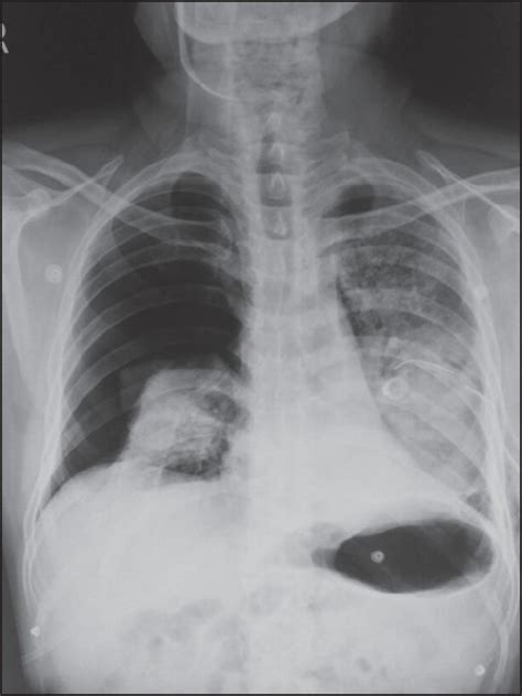 Chest X Ray Lateral View Showing Pneumothorax Download Scientific Vrogue