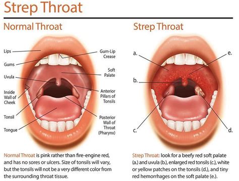 Strep Throat Medizzy