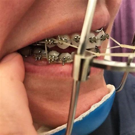 Pin von Tom auf Braces Zahnspange Zähne Badesalz
