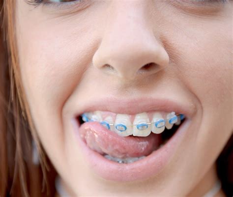 Pin By Evil H On Beautiful Braces Smiley Piercing Teeth Braces