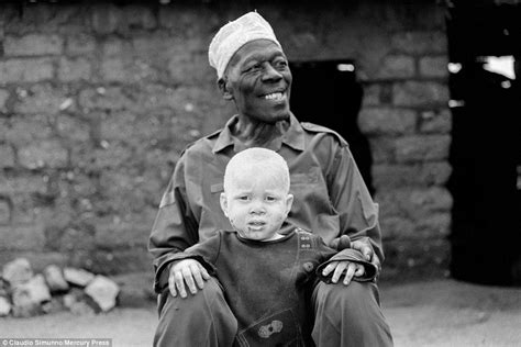 Tanzanias Albino Community Fear Being Killed For Their