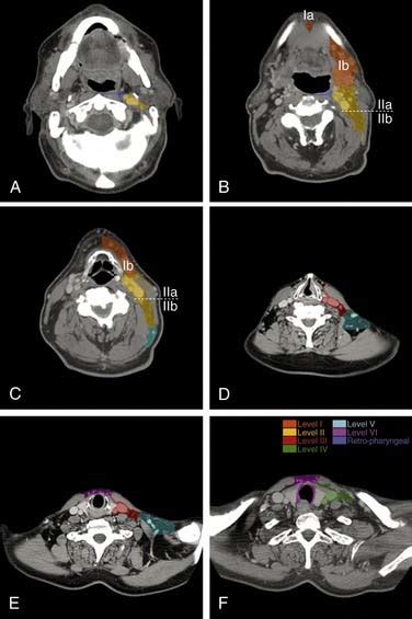 Radiation Therapy And Management Of The Cervical Lymph Nodes And