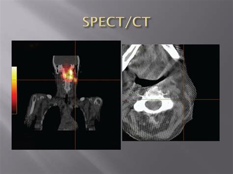 Ppt Role Of Sentinel Lymph Node Biopsy In Head And Neck Cancer