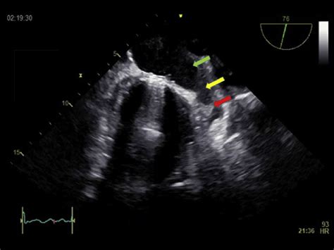Transesophageal Echocardiography In A Patient With Atrial Fibrillation